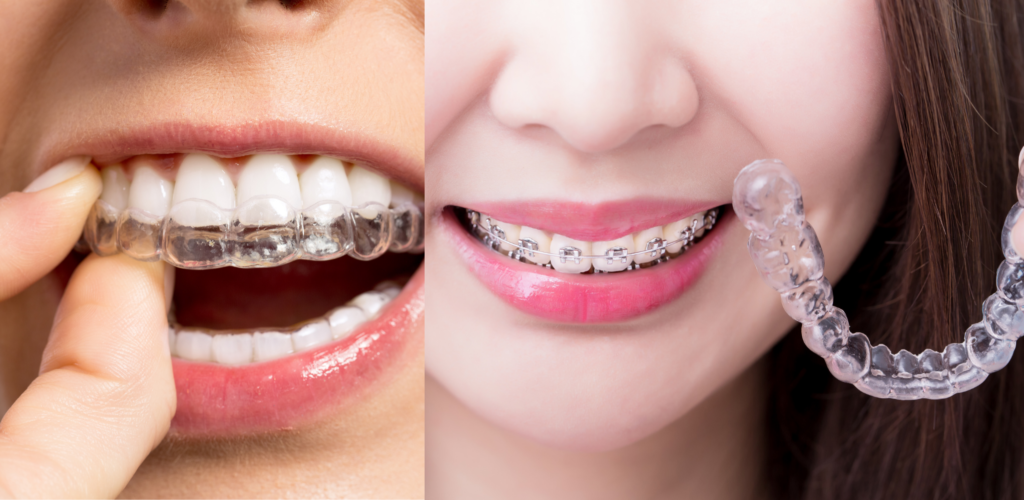 Invisible Braces - Todays Dental @ Greenville