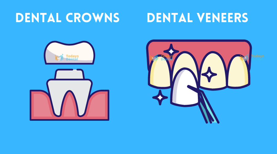 Todays Dental - Dental Crowns vs Veneers