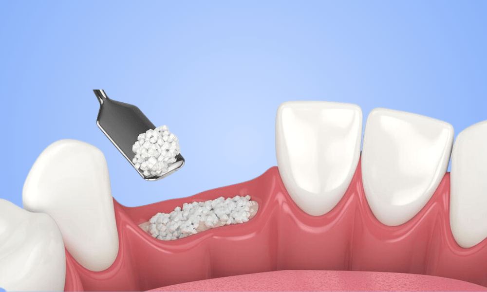 Why Choose Bone Grafting in Greenville?