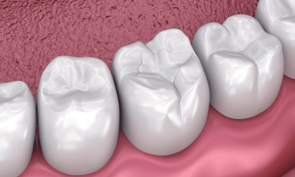 What Are Composite Fillings