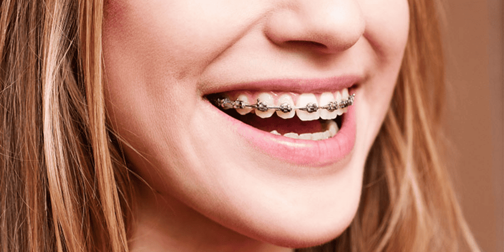 What Is Orthodontics?