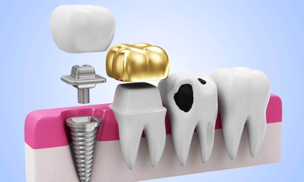 What Is Restorative Dentistry