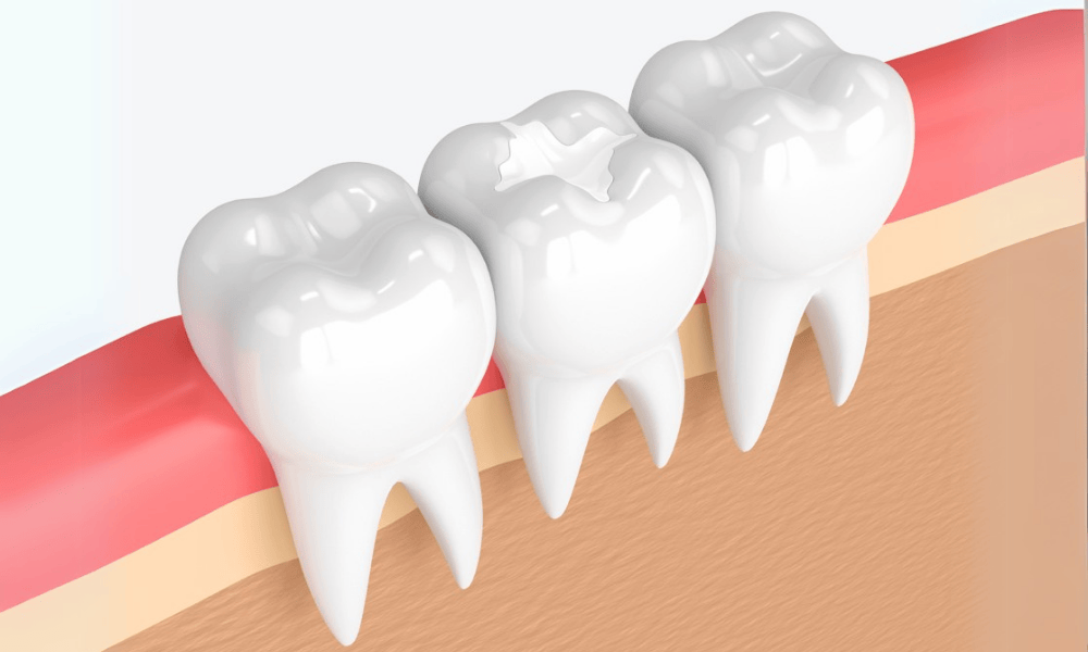 How Long Do Composite Fillings Last