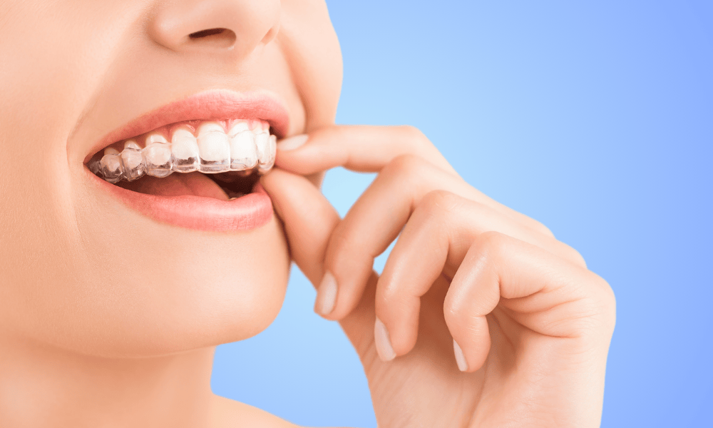 Invisalign and Braces Options