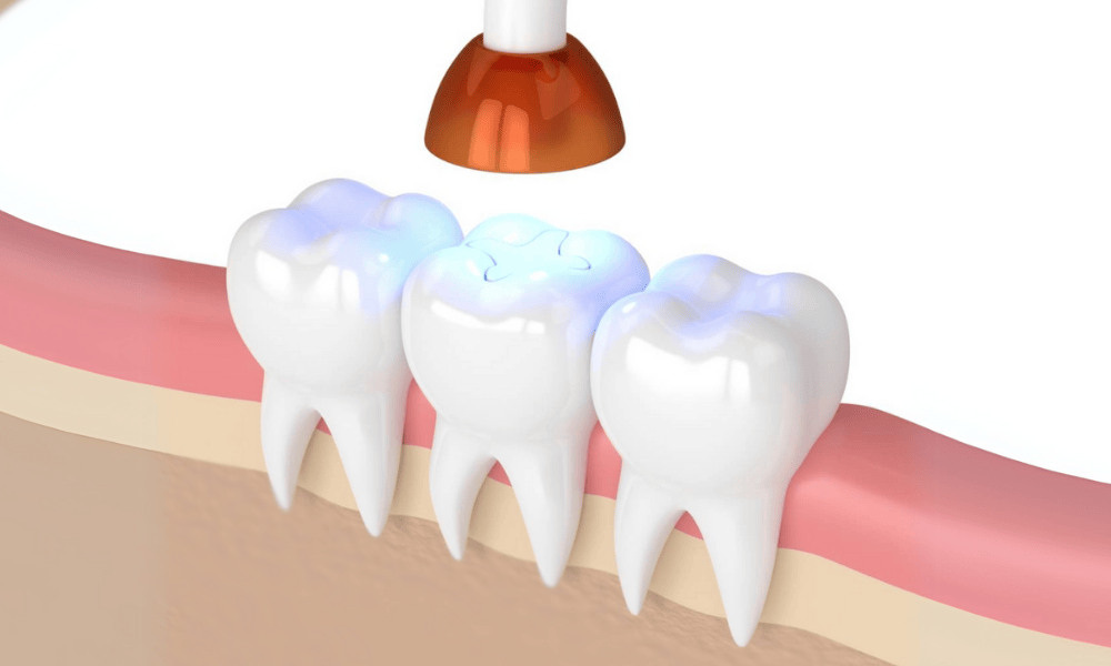 Composite Fillings Cost and Pricing Information in Greenville