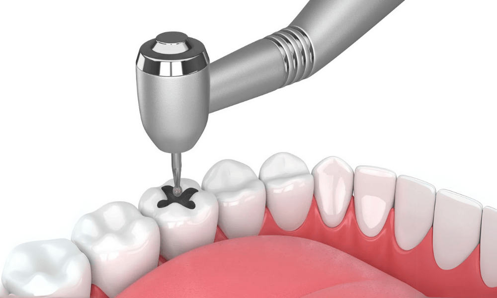 Composite Fillings Before and After