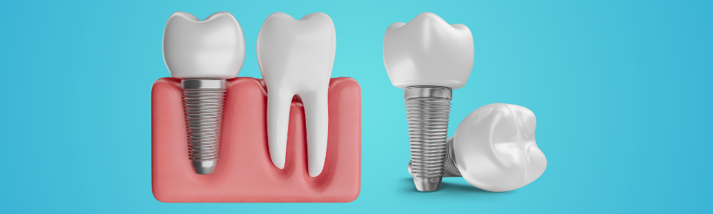 Dental Implants